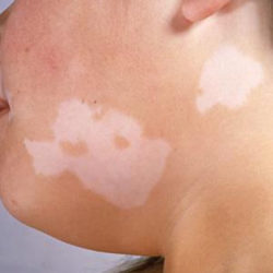 vitiligo-white-patches