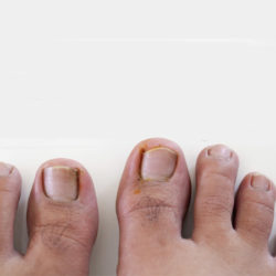 human foot and ingrown nail, onychocryptosis