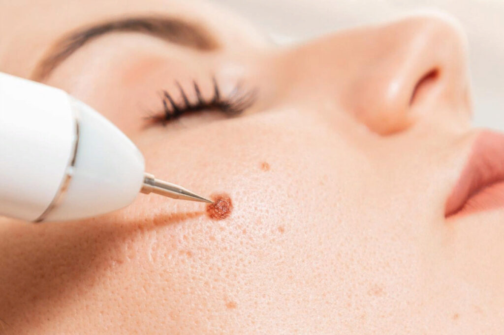 Wart & Mole Removal