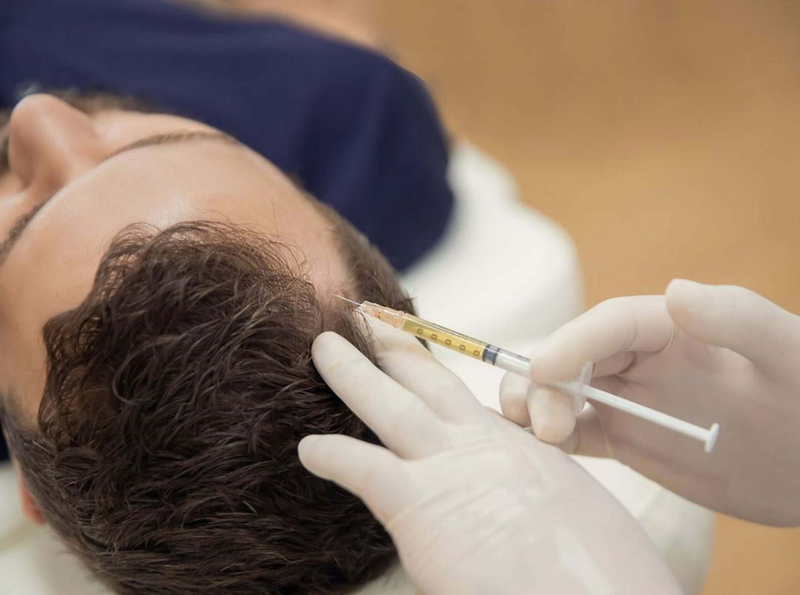 PRP Therapy for Hair Growth